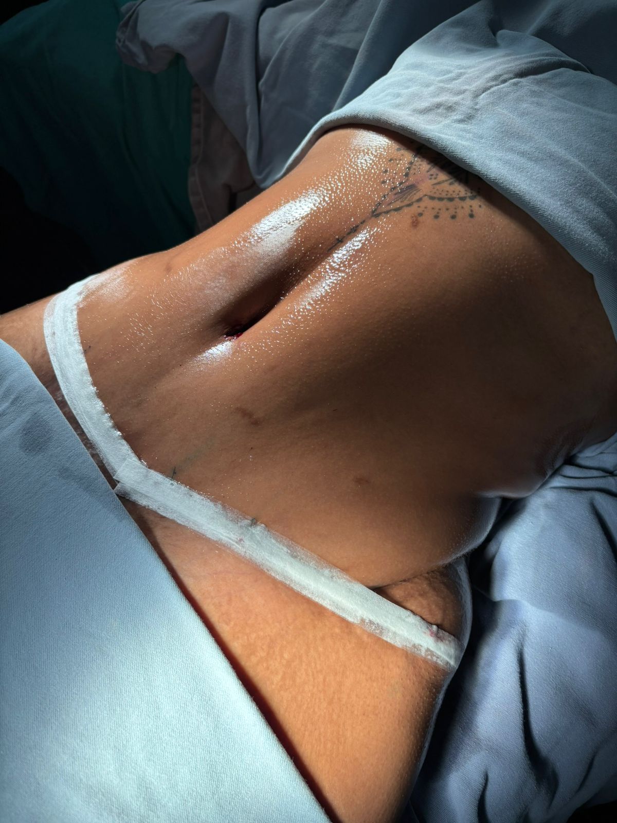 Resultado após cirurgia - Caso 4